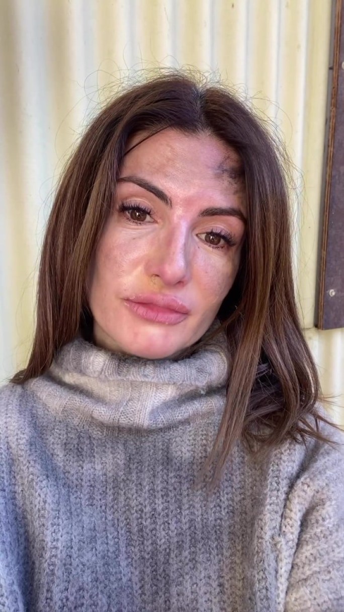 Home And Away star Ada Nicodemou leaves fans stunned after sharing shock ‘injury’ pics – but all is not as it seems